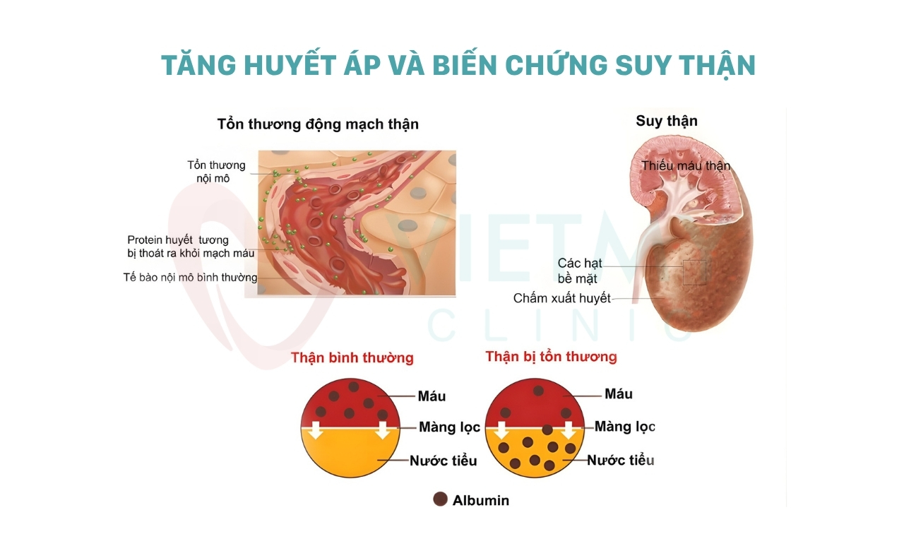 tang-huyet-ap-va-bien-chung-suy-than-viet-my-clinic-vmc