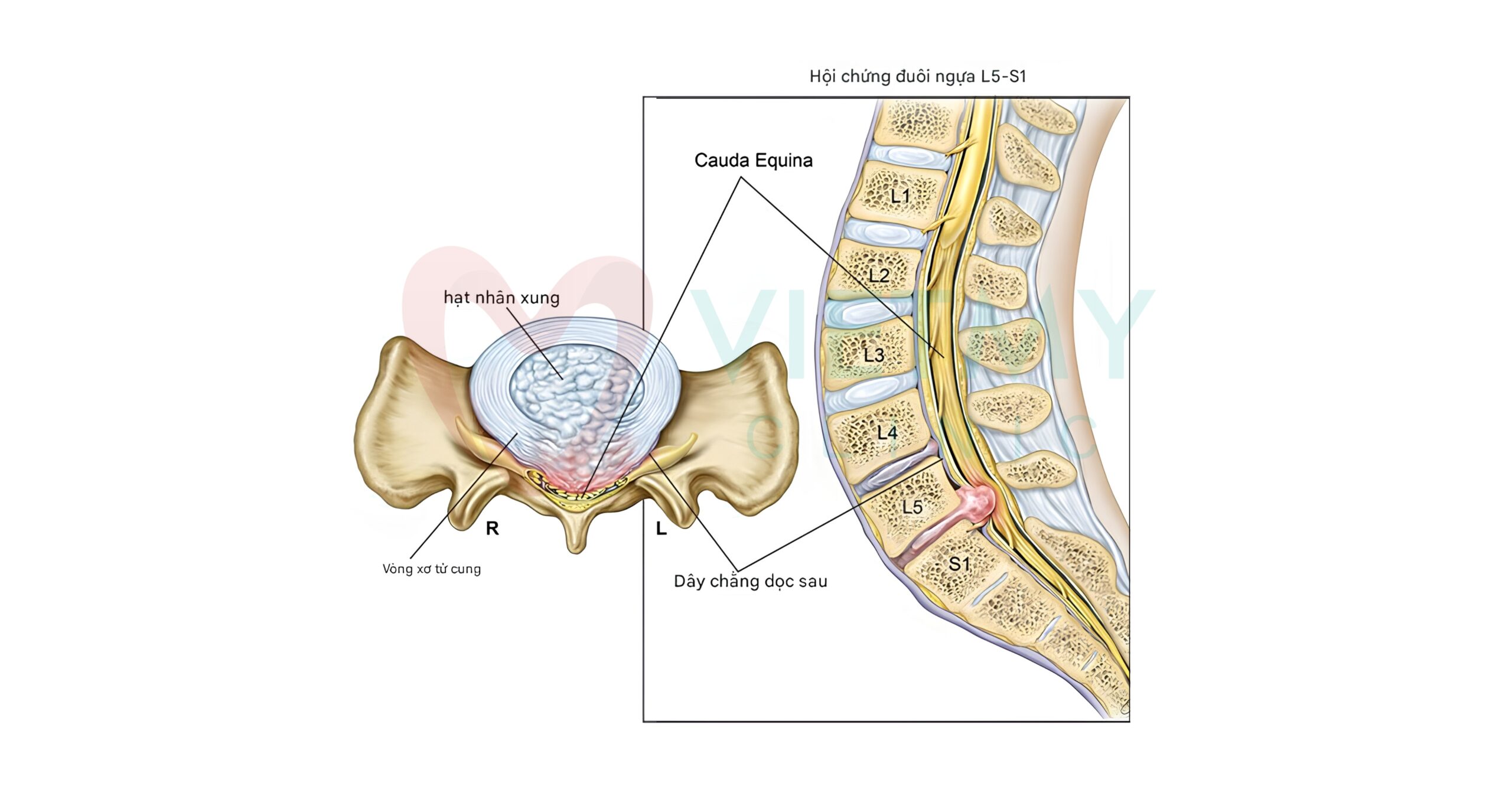 Hội chứng chùm đuôi ngựa (CES) dẫn đến rối loạn chức năng bàng quang và ruột