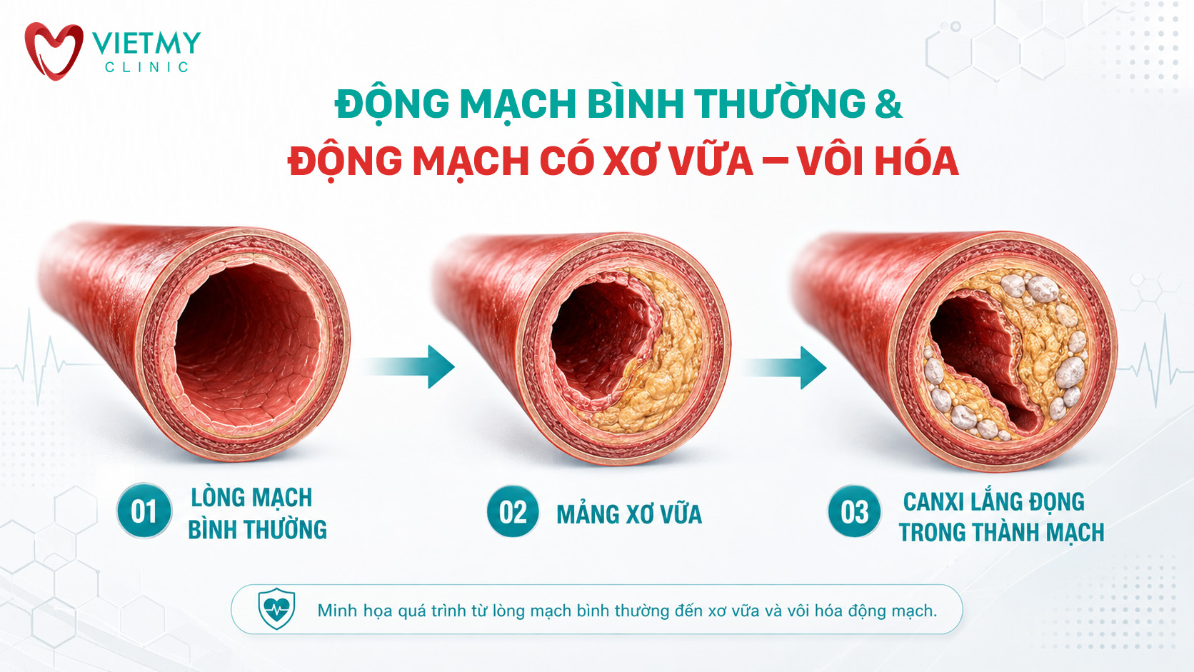 so-sanh-dong-mach-thuong-va-xo-hoa-viet-my-clinic-vmc